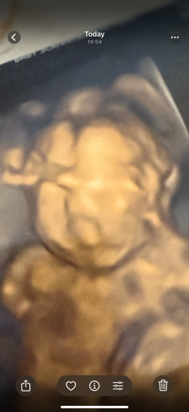 Do you think it is a cleft lip?
