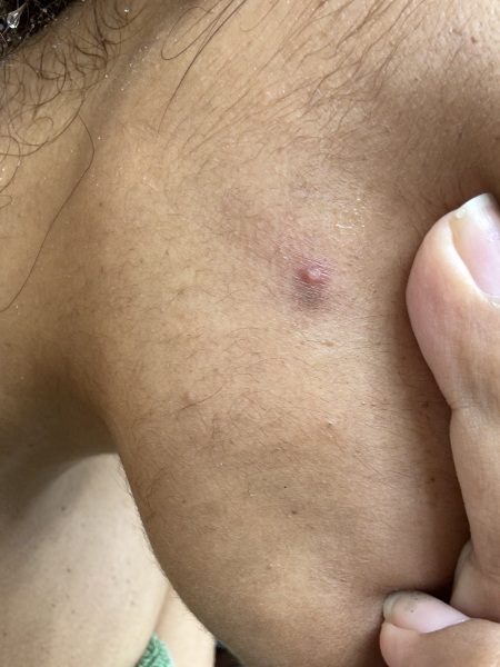 What is this spot on my face?