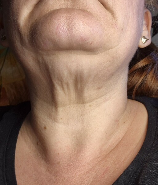 Weightloss & turkey neck