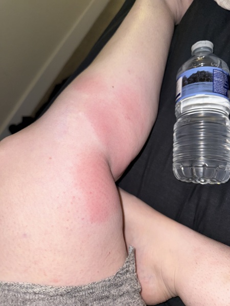 Legs on fire, what’s biting me? Should I be concerned about this?