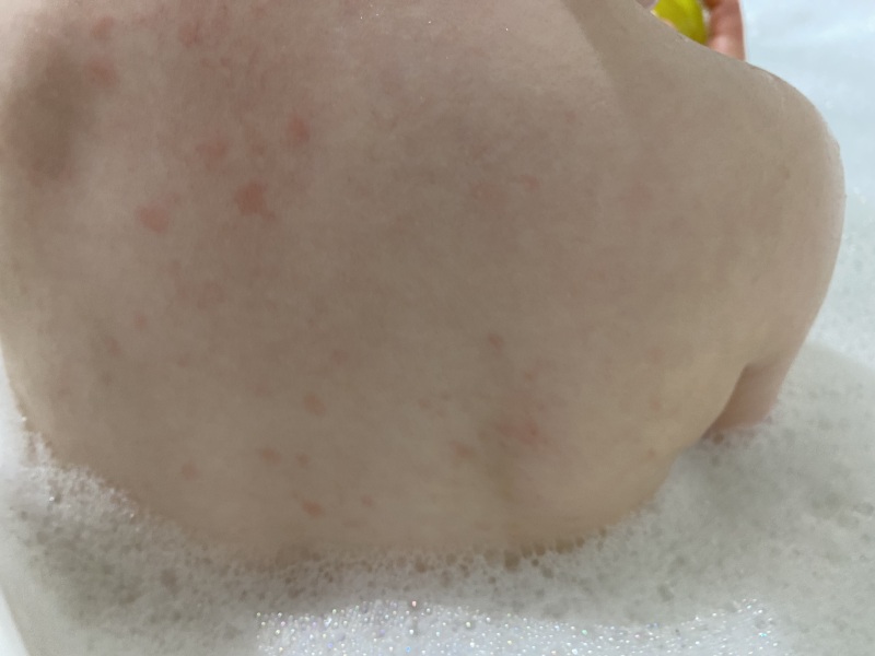 Another chicken pox one…