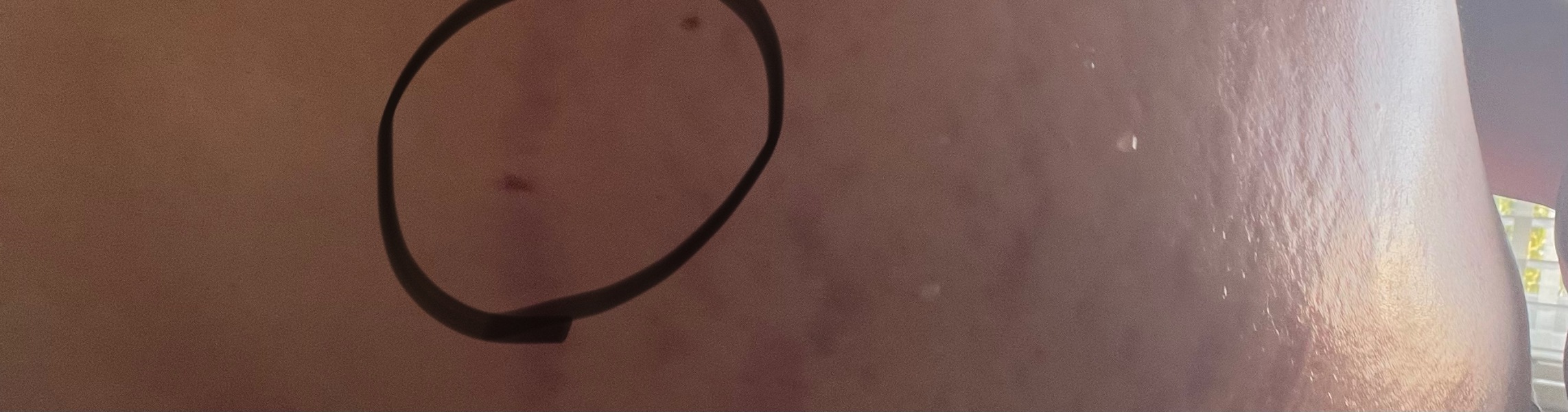 Stretch marks