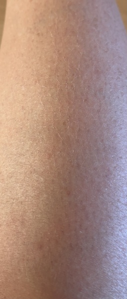 Why am I starting to get old lady legs! Kinda gone a bit cracked, what should I be putting on them ?
