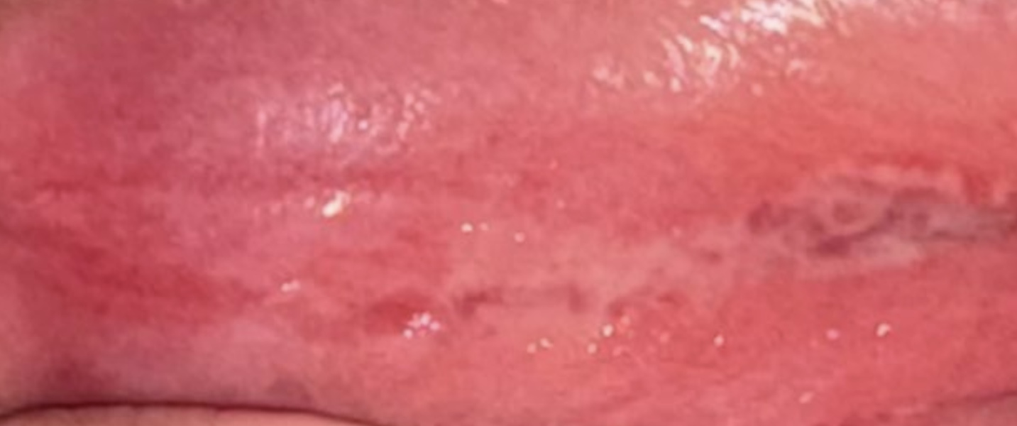 Thrush or herpes? ( Image below tmi )