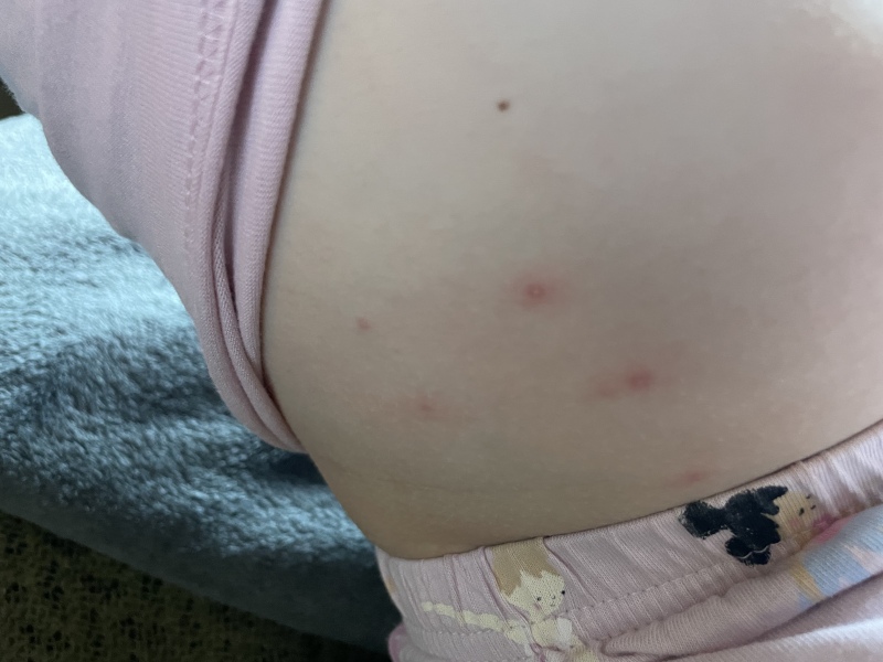 Is this start of chickenpox?