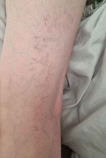 Are Spider veins like this normal on a 14 yr old?