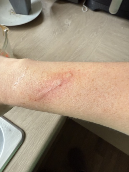 Burnt arm- advice.