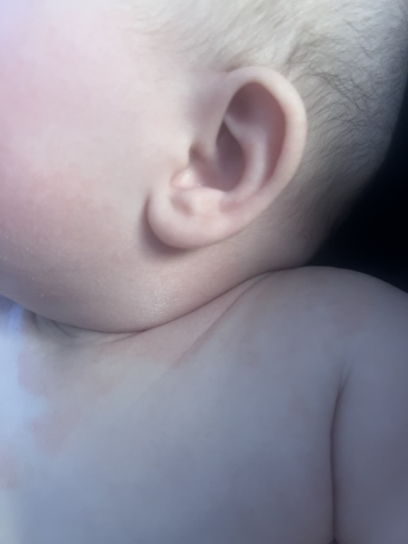 Any rash experts on here?