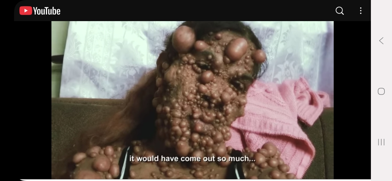 Neurofibromatosis Awareness Month