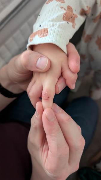 Any hand foot and mouth advice? At the the if my tether