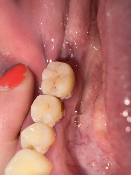 Tooth extraction day 7