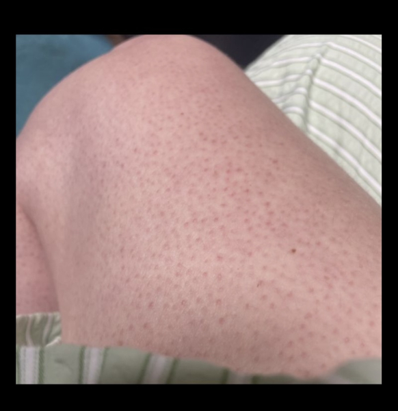 Fed up with keratosis pilaris