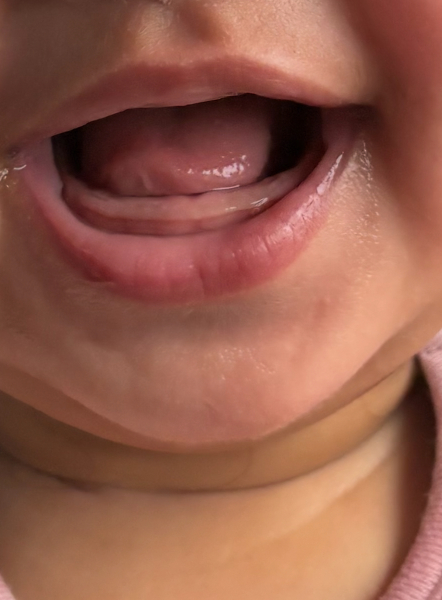 Is this two teeth coming through?