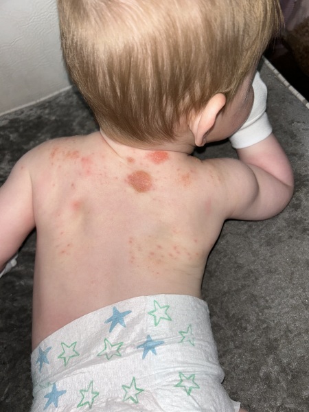 My baby’s eczema