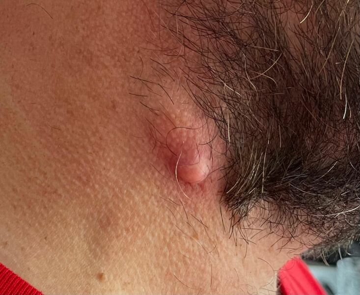 Subcutaneous Cyst - white head. How to drain?