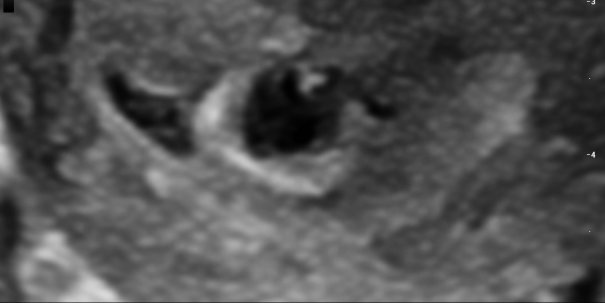 Ultra-sound possible SCH