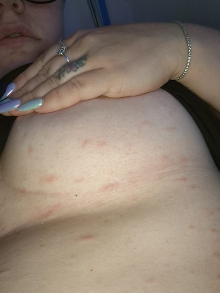 Rash all over breasts and torso