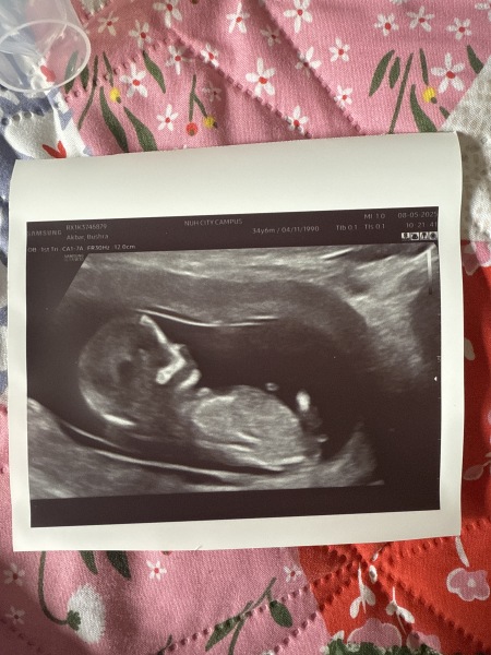 Gender prediction at 12 weeks 5days