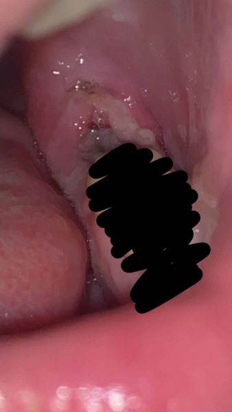Tooth extraction day 3