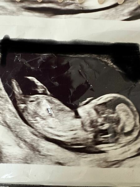 Boy or Girl 🩷🩵 12 week scan