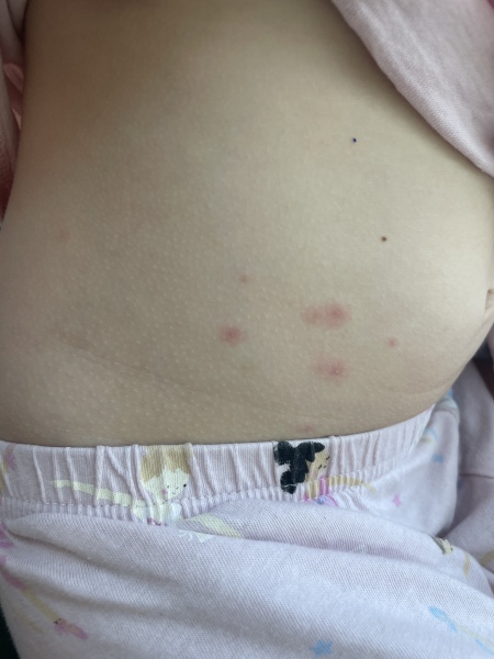 Is this start of chickenpox?