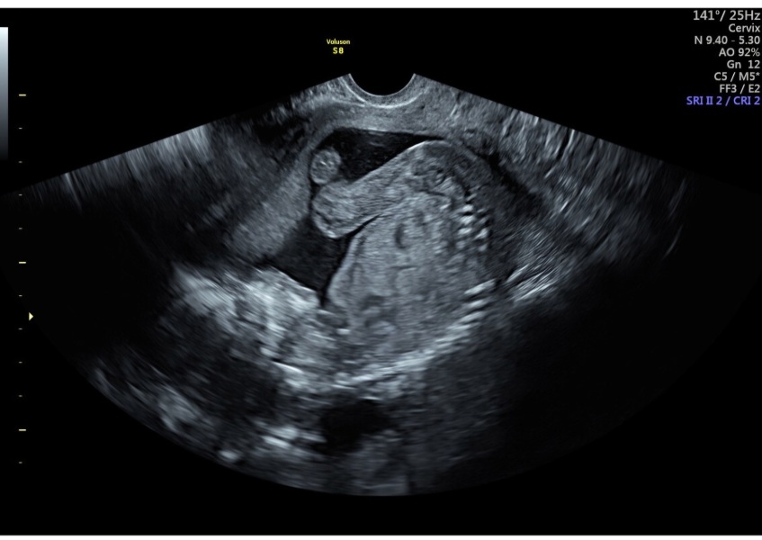 17 Weeks Low Amniotic Fluid