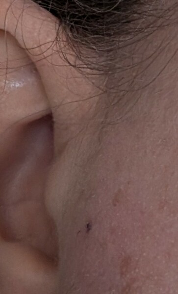 Blackhead that won't go!