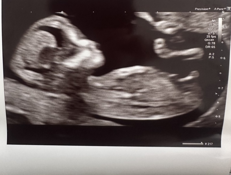 Gender guesses nub theory?