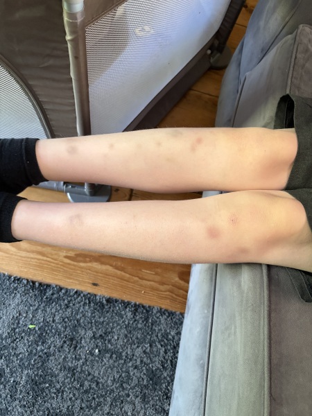 11 year old bruising