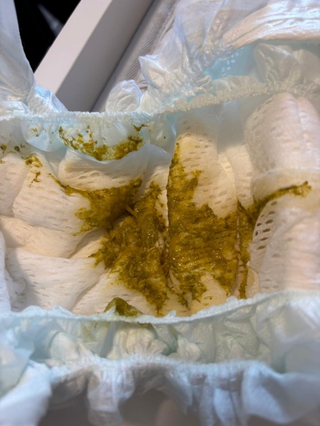 Could this be CMPA/mucus in poo? Picture warning