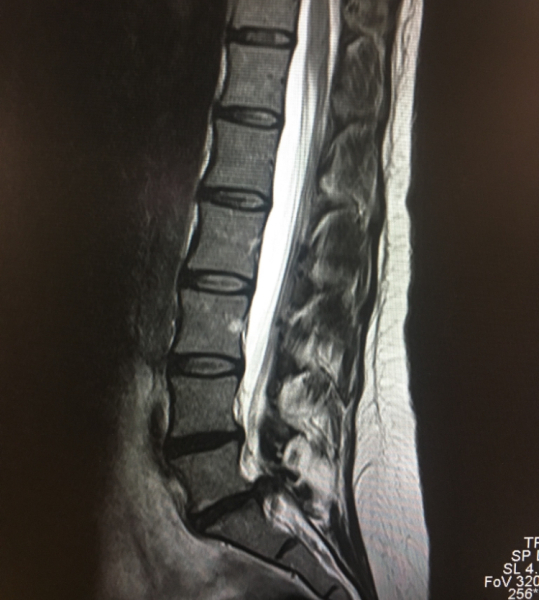 Sciatica hell. What might help?