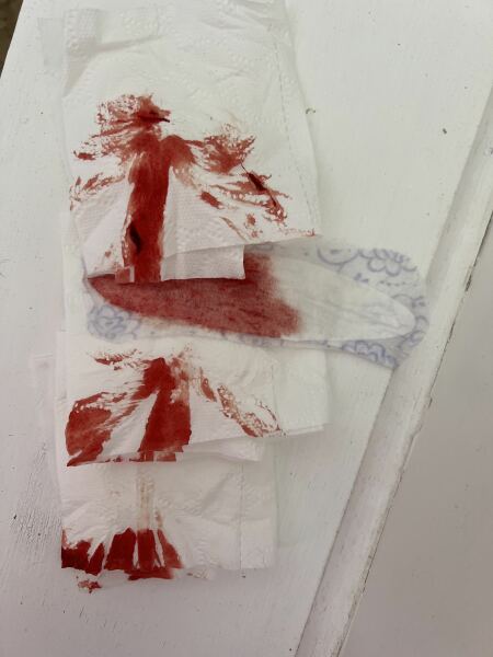 Bleeding at 7 weeks pregnant.
