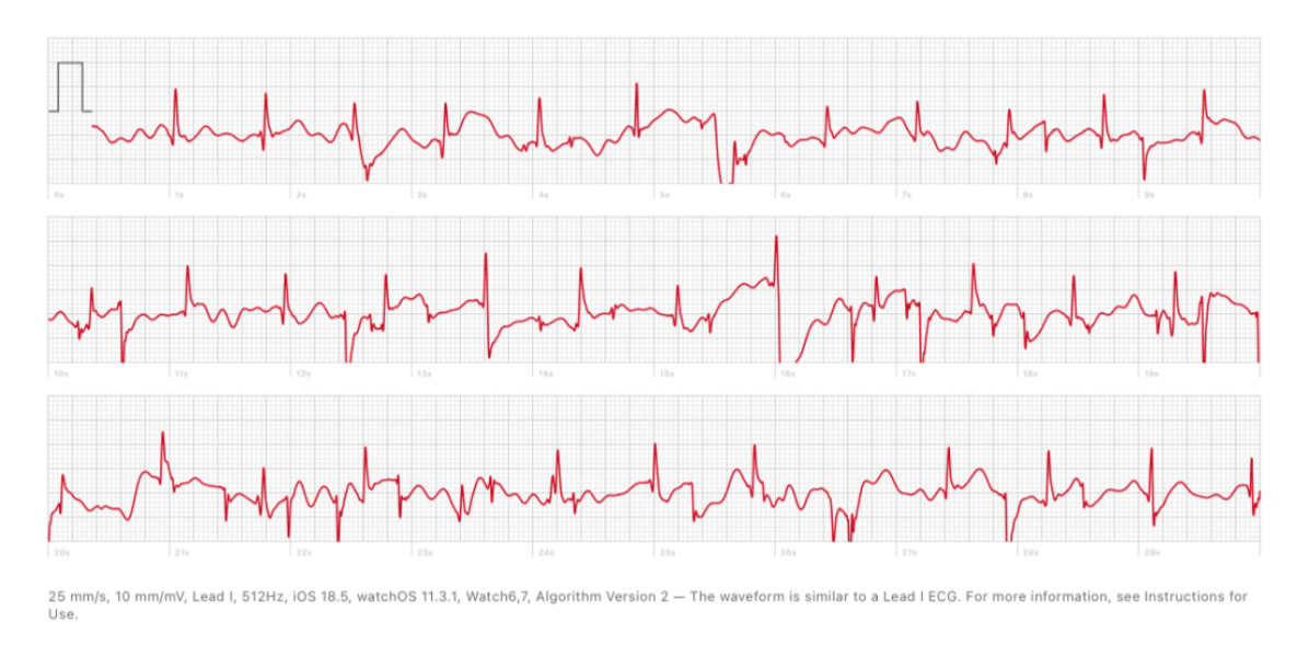 Apple Watch - Arterial Fibrillation 