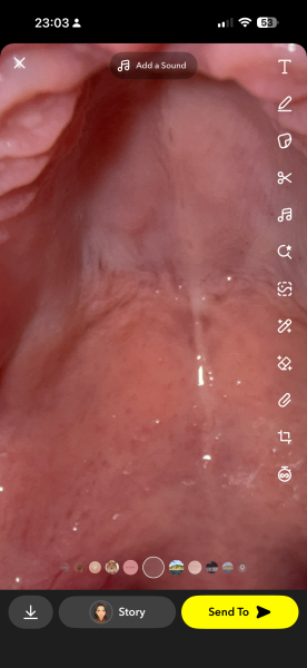 Any dentists about or GPs? Small hard lump roof of mouth