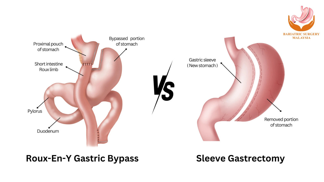 I'm having a gastric bypass when I weigh 9 stone