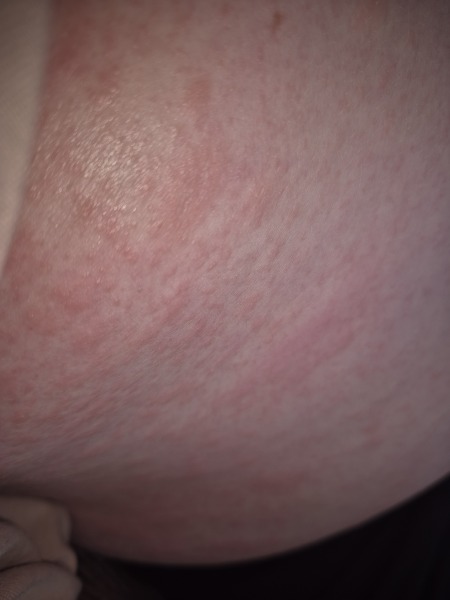 Rash all over breasts and torso