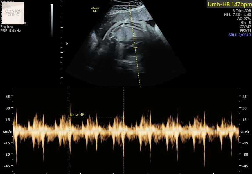 Any sonographers on here? Or anyone with slapped cheek knowledge?