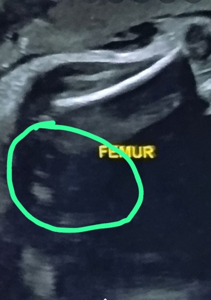 Gender prediction