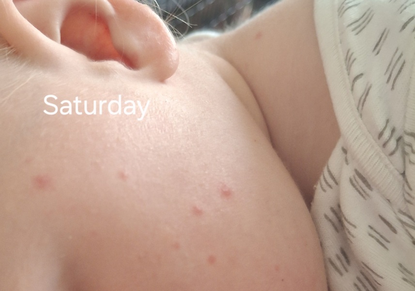 Is this chickenpox?