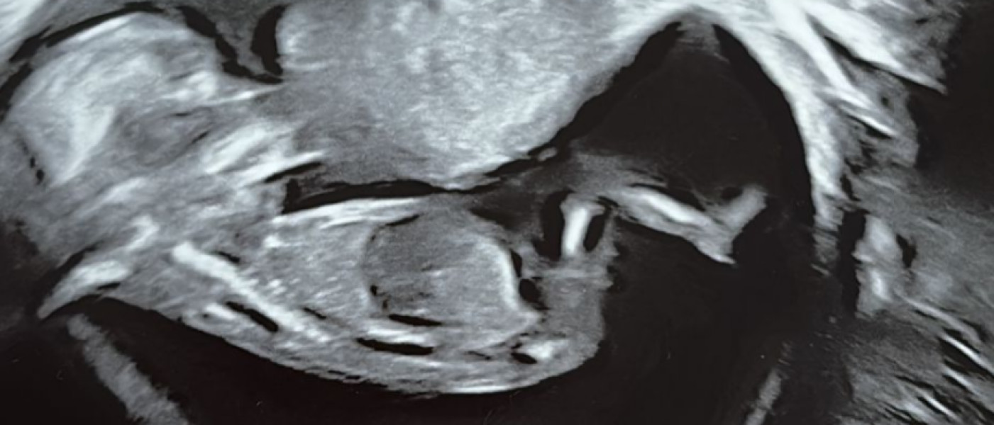 12 week scan can you tell the sex?