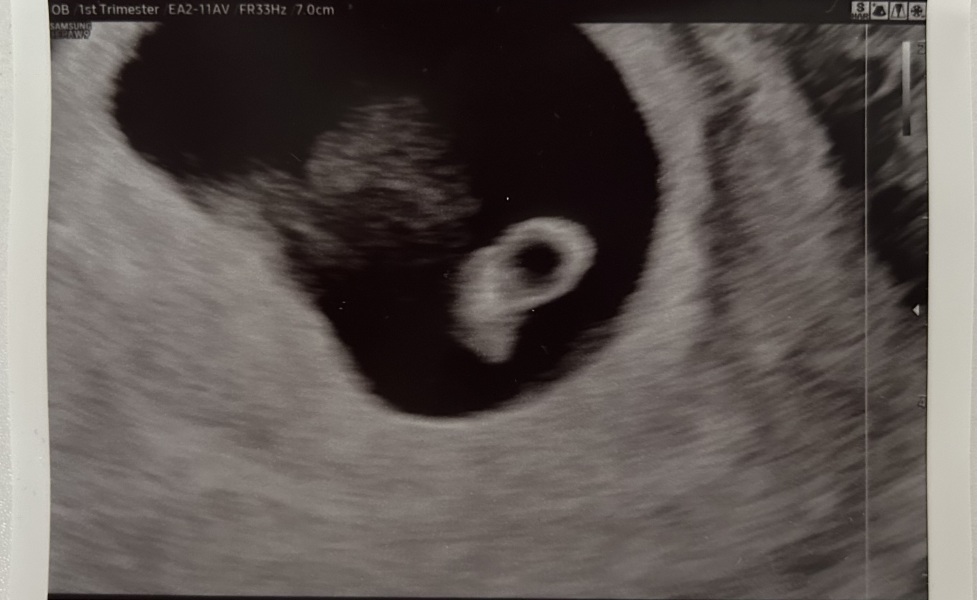 Possible Molar Pregancy