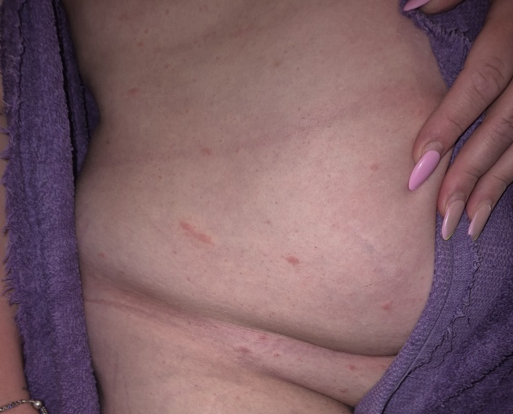Rash