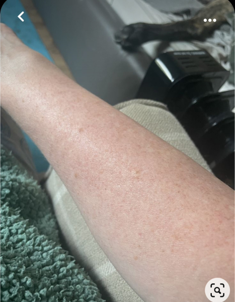 Fed up with keratosis pilaris