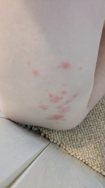 Is this Chicken pox?