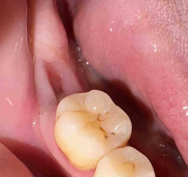 Tooth pain