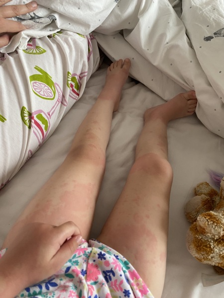 Erythema Multiforme?