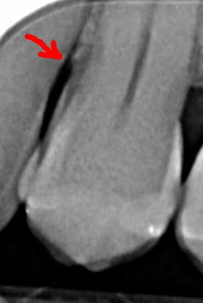 Any dentists around? Could you please tell me if I'm right? Xray