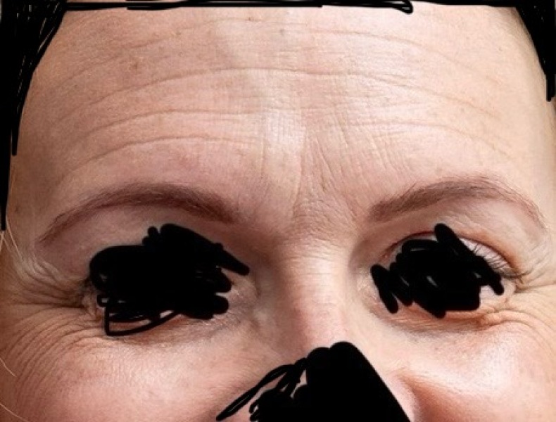 Botox or something else?