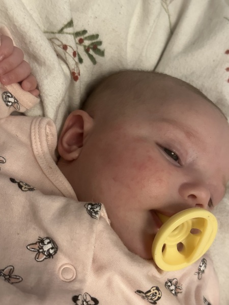 3 month old baby acne?