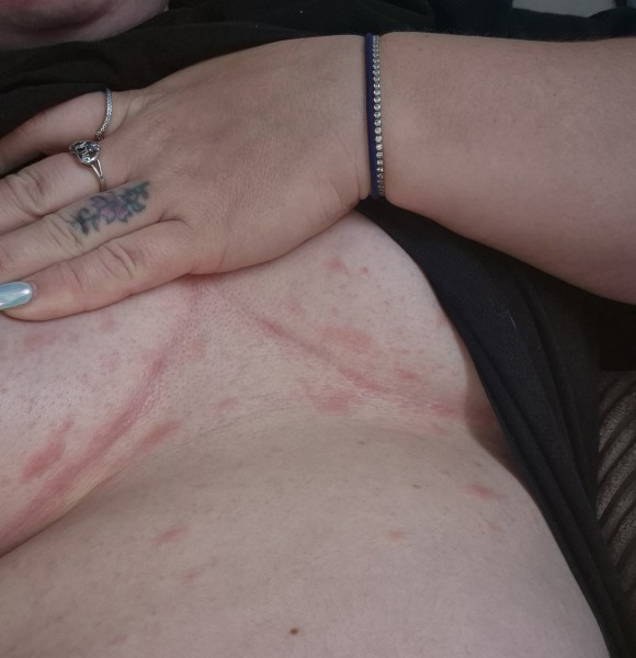 Rash all over breasts and torso